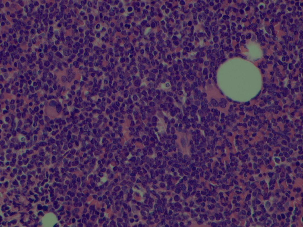 Bone marrow core biopsy with B-lymphoblastic leukemia/lymphoma (400X)